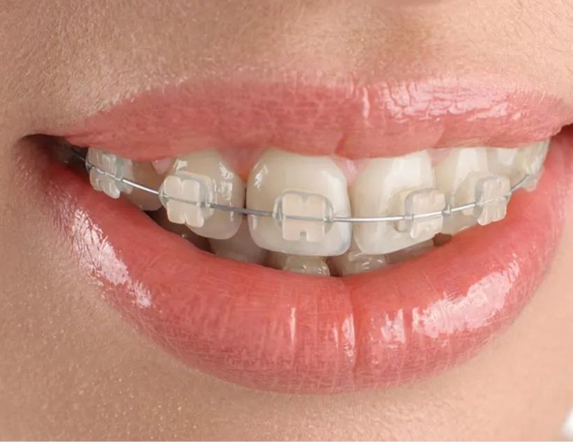 Clear ceramic braces