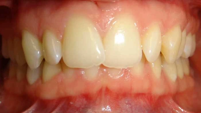 Clear Aligners before treatment
